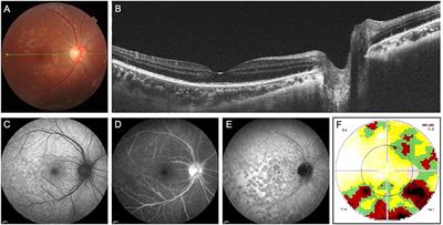 Case report: Visual snow as the presenting symptom in multiple evanescent white dot syndrome. Two case reports and literature review